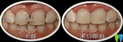 廈門(mén)宏沅膛謝良偉前牙美容性修復(fù)效果對(duì)比圖