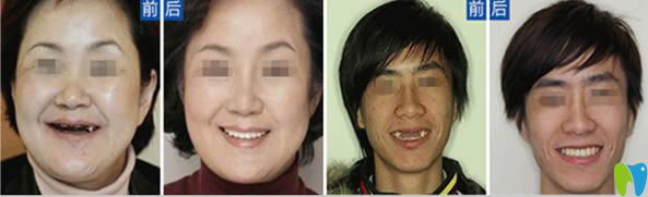 河源拜博種植牙前后對(duì)比效果