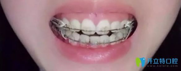 孝感口腔牙齒矯正效果