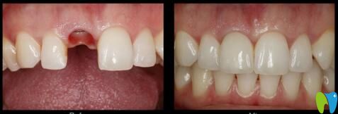 朝陽牙博士牙齒缺失種植效果