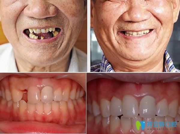 長春拜博口腔種植牙真人案例 長春拜博口腔種植牙真人案例