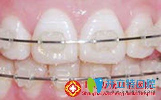 MBT直絲弓隱形正畸技術(shù)