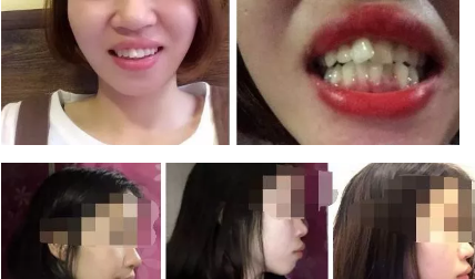 西安諾貝爾口腔做的牙齒矯正，給有備孕又想帶牙套的