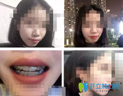 帶上牙套后吃東西真的不方便