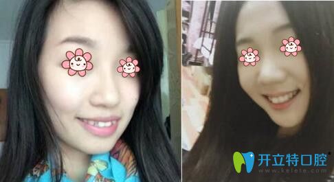 鄶濱醫(yī)生齙牙矯正案例