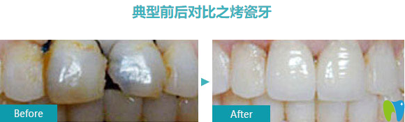 烤瓷牙前后對比