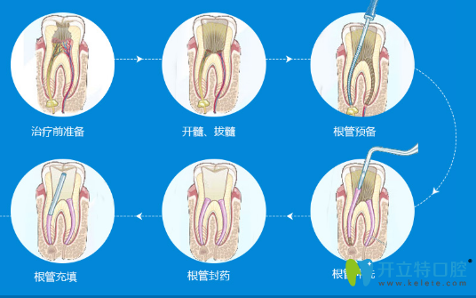 顯微根管治療過程