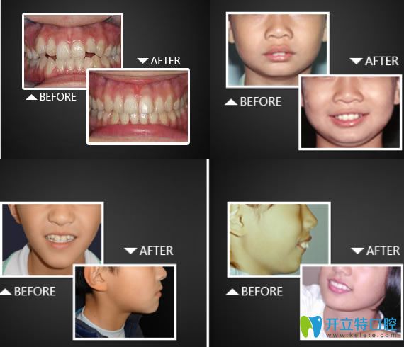 長春拜博口腔正畸真人案例