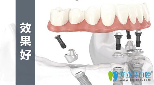 all-on-4種植技術效果 all-on-4種植技術效果