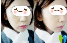 牙齒矯正后就好像整容了下頜角一樣