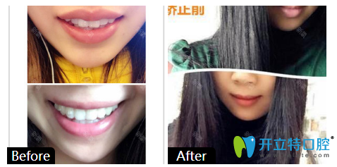 廣州柏德口腔3M金屬進口托槽矯正牙齒案例 廣州柏德口腔3M金屬進口托槽矯正牙齒案例