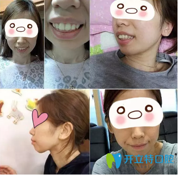 看我在西安藝星口腔科做的牙齒矯正手術(shù)日記