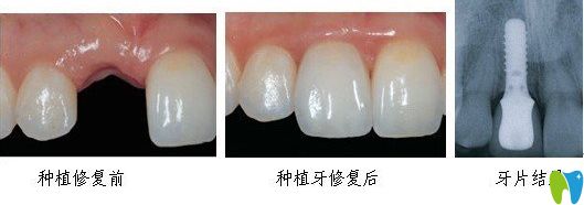 唐山拜博單顆即刻種植牙 唐山拜博單顆即刻種植牙
