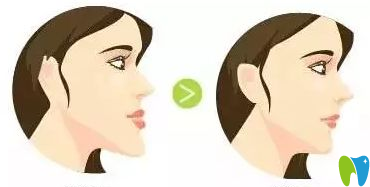 地包天如何預(yù)防？治療時(shí)間是什么時(shí)候？