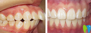 濰坊可恩口腔魏奉才上頜矯正效果對比圖