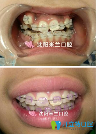 范阿丹院長牙齒矯正案例 范阿丹院長牙齒矯正案例