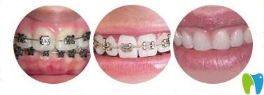 長(zhǎng)沙美萊口腔兒童正畸矯正