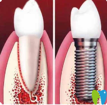 石家莊樂昂口腔種植牙宣傳圖 石家莊樂昂口腔種植牙宣傳圖