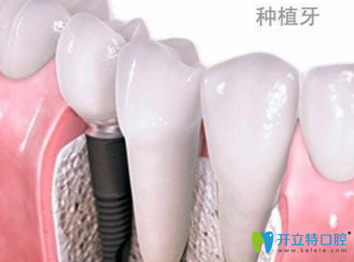 牙齒缺失影響健康 榆林長(zhǎng)虹口腔德國(guó)Bego種植牙還你整齊牙齒