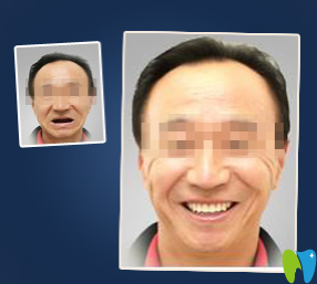 廈門宏沅膛口腔種植牙前后效果對比圖