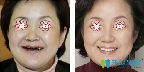 沈陽康貝佳口腔“即刻用”種牙案例