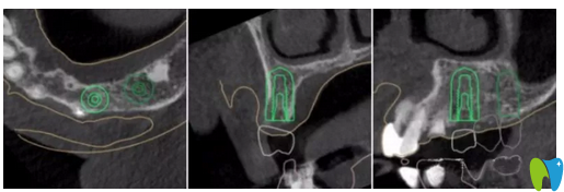 種植牙術(shù)前左上4牙位模擬種植圖 種植牙術(shù)前左上4牙位模擬種植圖