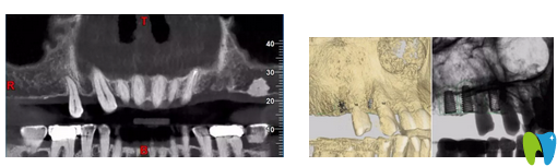 術(shù)前種植牙CT拍攝 術(shù)前種植牙CT拍攝