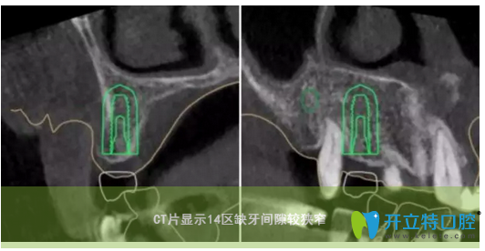 種植牙ct 種植牙ct