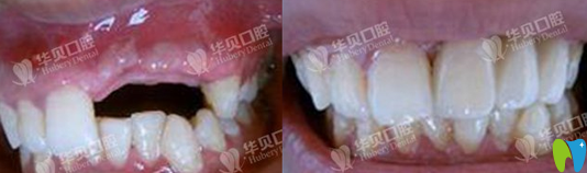 濰坊華貝種植牙效果對(duì)比圖