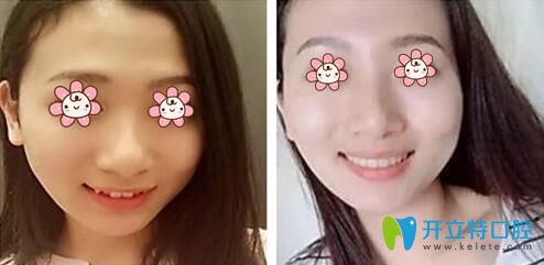 權(quán)花淑牙齒咬合矯正案例