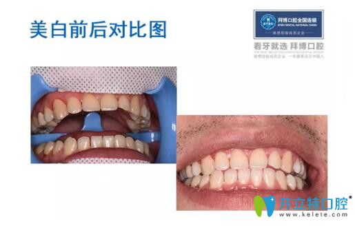 冷光美白牙齒前后對比