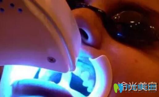 選擇冷光美白治療方案