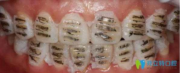 做瓷貼面前對牙齒進行打磨 做瓷貼面前對牙齒進行打磨