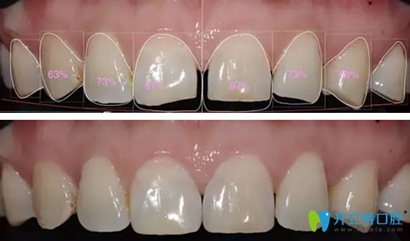 術前微笑設計和模擬瓷貼面修復效果 術前微笑設計和模擬瓷貼面修復效果