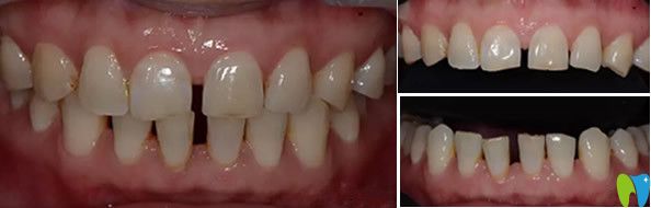 通化愛德口腔牙齒瓷貼面修復前 通化愛德口腔牙齒瓷貼面修復前