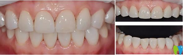 通化愛德口腔瓷貼面修復效果 通化愛德口腔瓷貼面修復效果