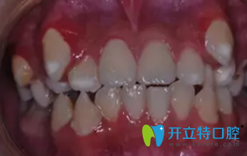 漢中小虎牙口腔牙齒正畸前照片