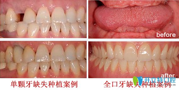 深圳拜博口腔好不好？深圳拜博口腔牙齒種植案例效果來證明實力