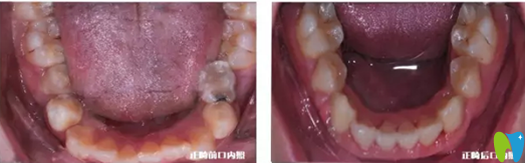 小虎牙口腔兒童牙齒正畸下牙正畸前后對比照