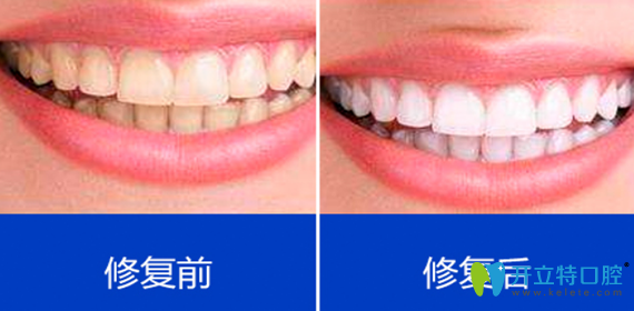 深圳拜博口腔靠譜不？氟斑牙全瓷牙貼面修復(fù)案例效果來證明