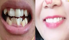 深圳拜博口腔一年半牙齒矯正結(jié)束啦，接下來開始戴保持器