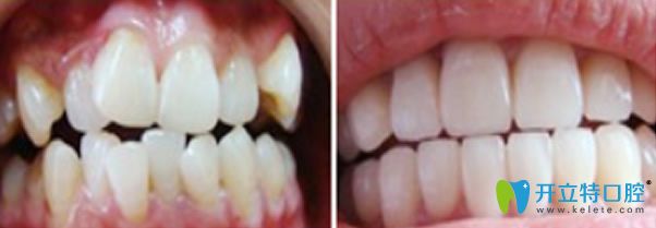 常州北極星口腔矯正前后對比效果圖