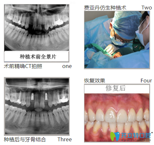 黎強給口牙缺失、牙槽骨萎縮幻陣采用德國費亞丹種植技術(shù)種牙過程圖
