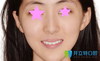 深圳同步齒科牙齒正畸半年后恢復效果