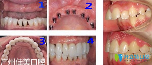 廣州佳美口腔牙齒種植+齙牙矯正效果對(duì)比圖 廣州佳美口腔牙齒種植+齙牙矯正效果對(duì)比圖