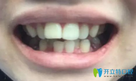 深圳格倫菲爾牙齒矯正后一周