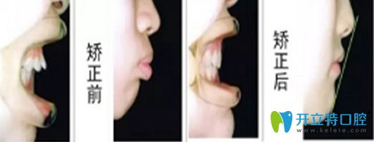 太平洋口腔牙齒矯正前后對比圖 太平洋口腔牙齒矯正前后對比圖