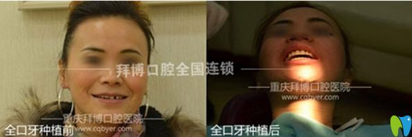 重慶拜博口腔全口牙種植效果案例 重慶拜博口腔全口牙種植效果案例