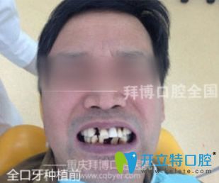重慶拜博口腔牙齒種植前 重慶拜博口腔牙齒種植前