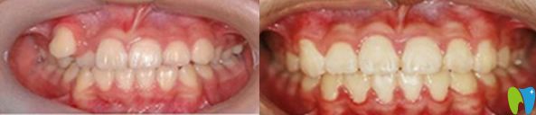 太平洋口腔牙齒矯正前后對比圖
